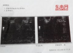 漳州：两次诊断不一样 “被遗忘”的右肾结石